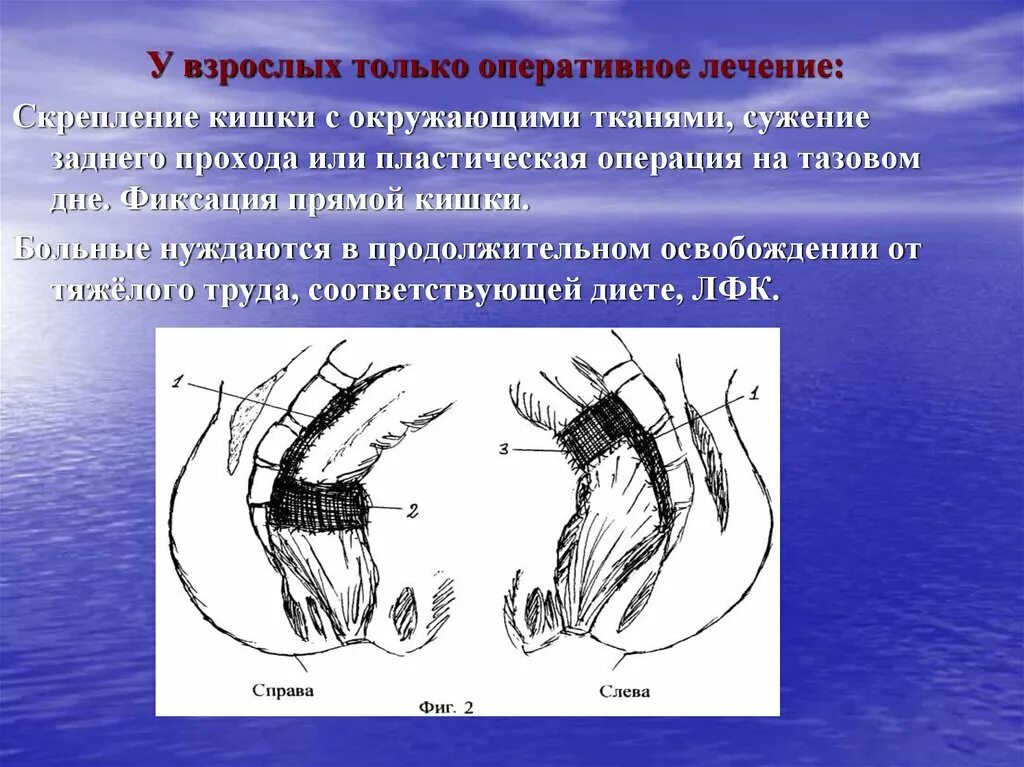 Заболевания прямой кишки. Стриктутура прямой кишки. Колющая боль в заднем проходе