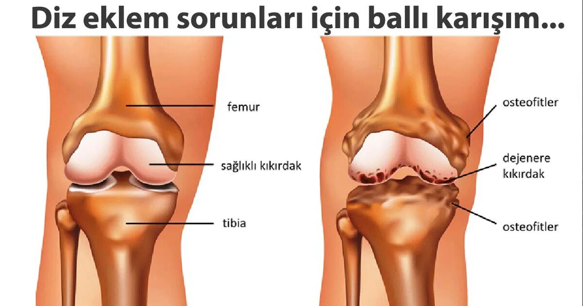 Остеофиты коленного сустава. Knee Arthritis. Болят колени после велосипеда