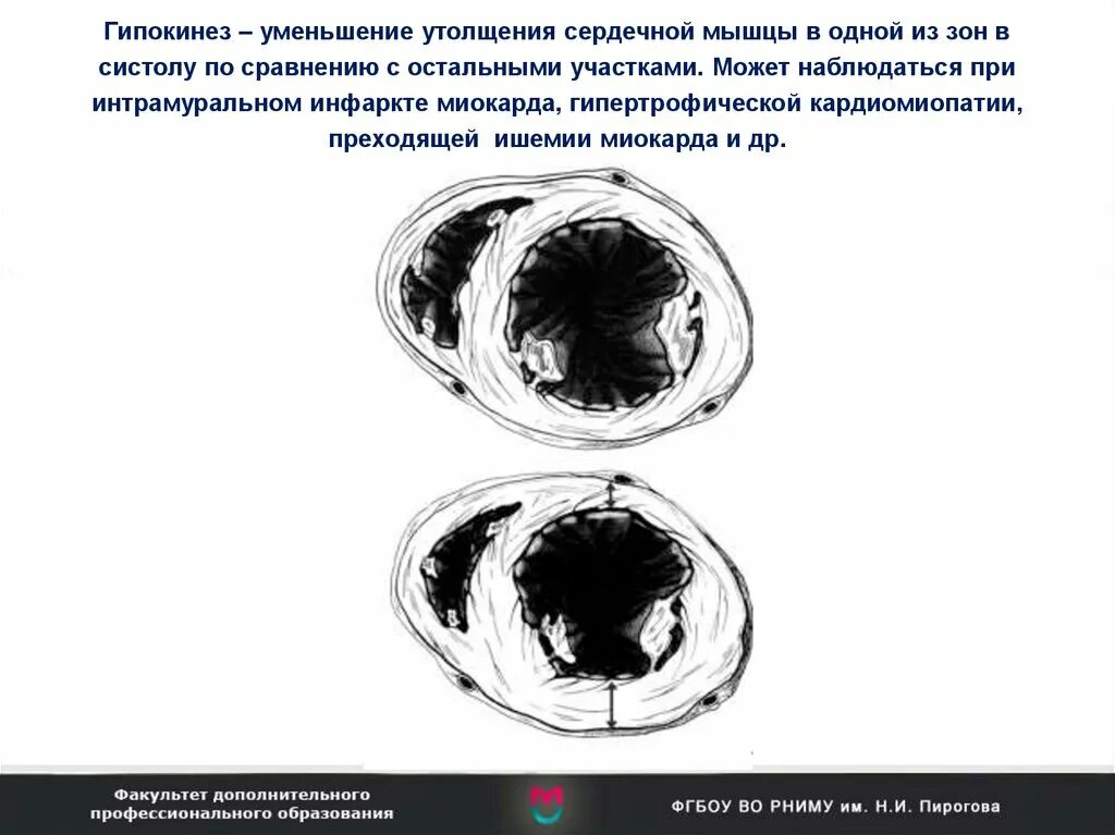 Гипокинез передних сегментов. Гипокинезия миокарда эхокг. гипокинезия левого желудочка. гипокинез миокарда узи. зоны гипокинеза эхокг.