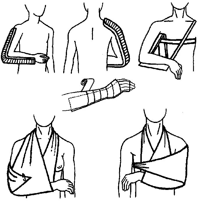 алгоритм оказания пмп при закрытом переломе. оказание первой медицинской помощи при переломе ноги кратко. действие при переломе руки. первая помощь при переломемруки. порядок оказания первой помощи при переломах конечностей.