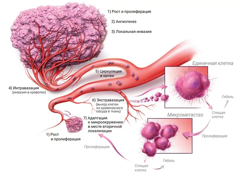 Пролиферация раковых клеток. Этапы метастазирования опухолевых клеток. Схема метастазирования опухоли. Этапы образования раковых клеток. Без признаков инвазии