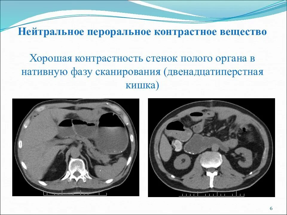 Плохо после контраста кт. Контрастное вещество при кт. введение контрастного вещества при кт. пероральное контрастирование при кт. вещество для контраста при кт.