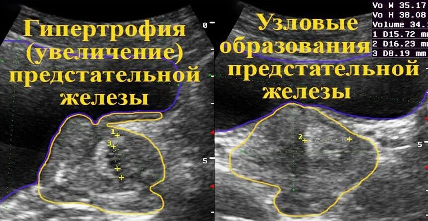 Подозрения на простату. Размер простаты у мужчин. Объем простаты при простатите. Нормальный объем простаты.