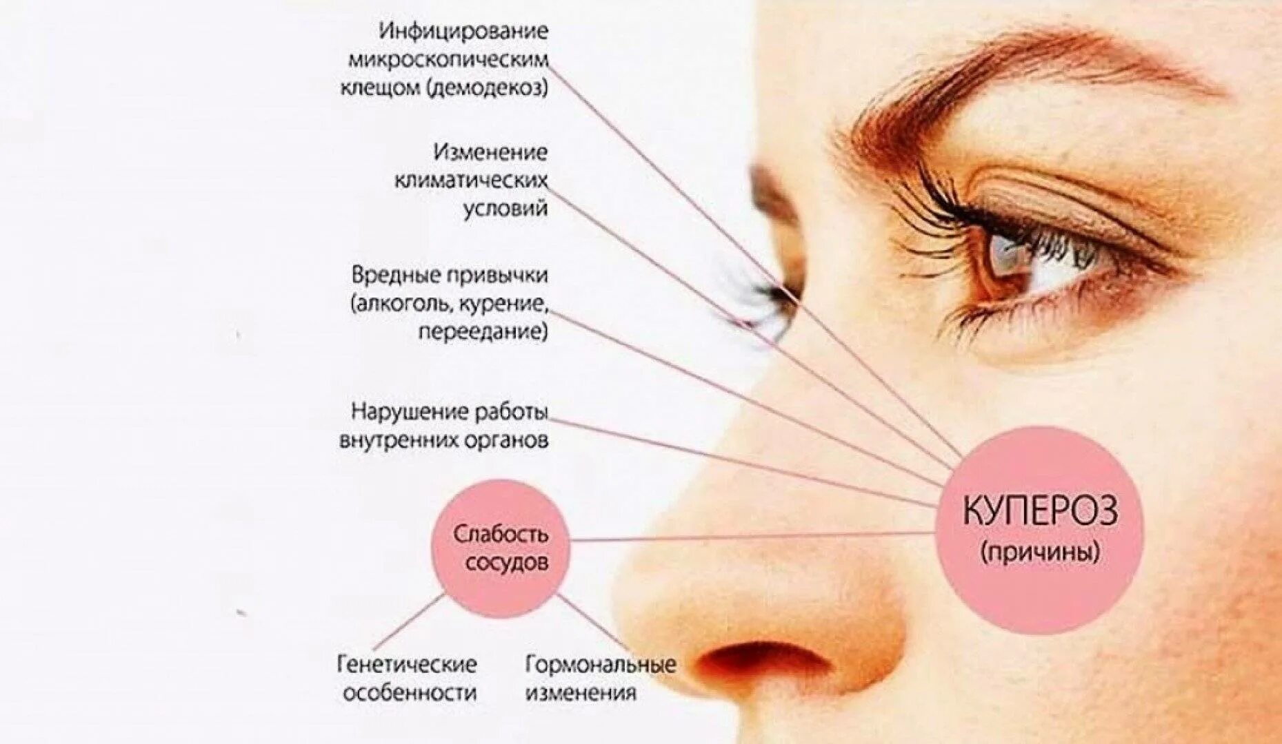 Почему на лице образуются. Причины появления купероза.