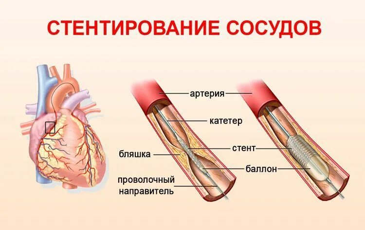 Как ставят стент