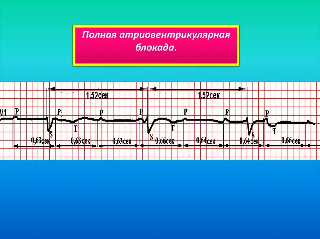Атриовентрикулярная блокада признаки. Полная АВ блокада. Полная атриовентрикулярная блокада. Атриовентрикулярнпя блокпжа. Полная артеровентрикулярная блокахжа.