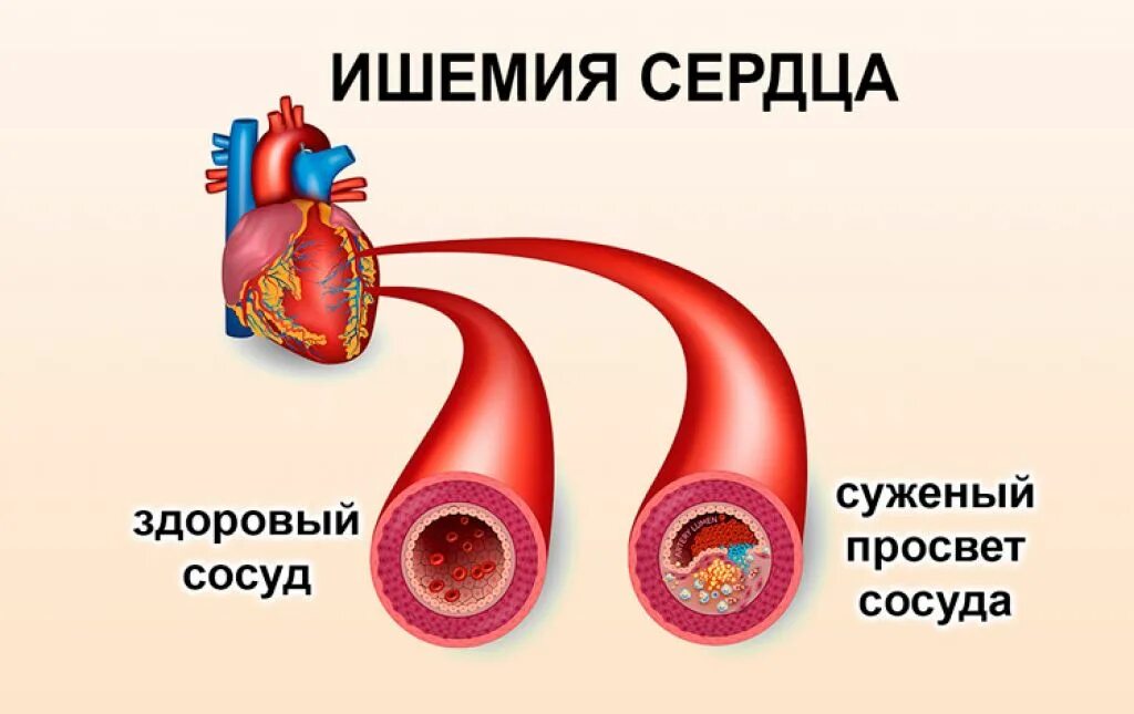 Ишемия крови. Ишемическое заболевание сердца.