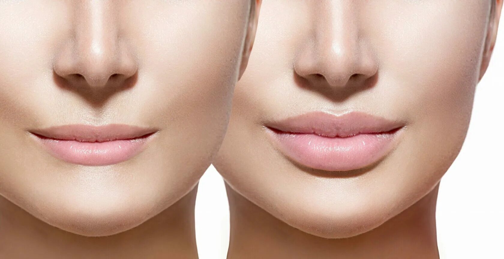 Биоревитализация губ до и после. Контурная пластика филлерами. Красивая форма губ. Красивые губы.