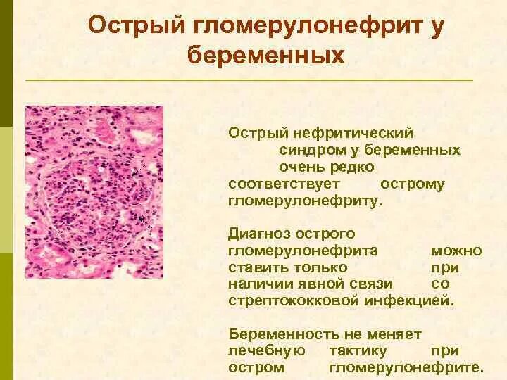 Гломерулонефрит с нефритическим синдромом. Гломерулонефрит с нефритическим синдромом