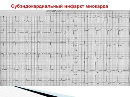 Субэндокардиальный инфаркт