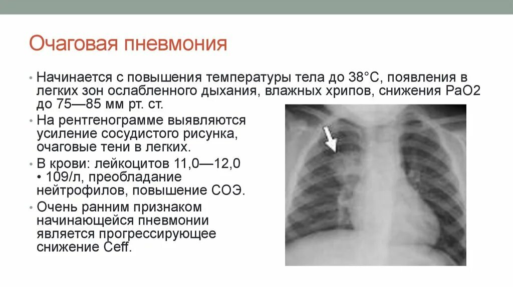 Пневмония признаки у взрослых. Внебольничная очаговая пневмония рентген. Очаговая пневмония рентген описание. Пневмония у детей на рентгене с описанием. Очаговая пневмония рентгенограмма у детей.