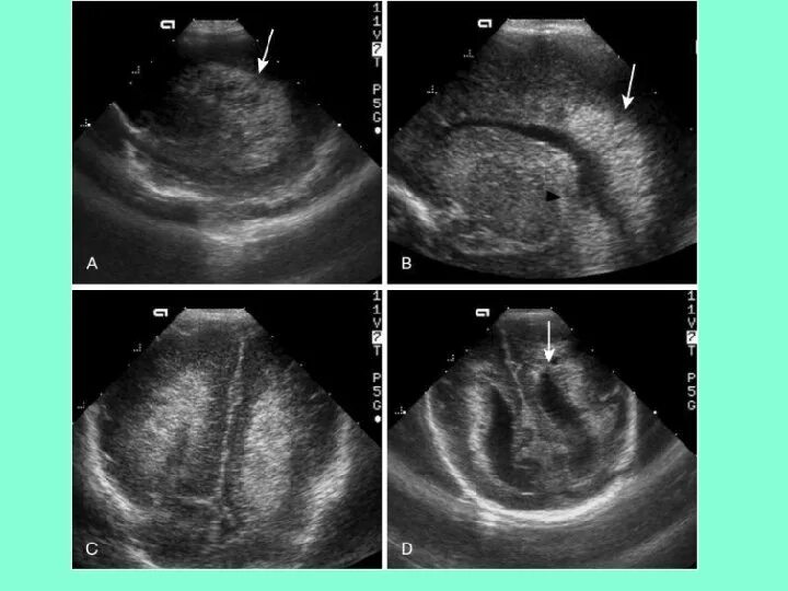 Нейросонография новорожденных. НСГ гипоксически ишемическое поражение ЦНС.