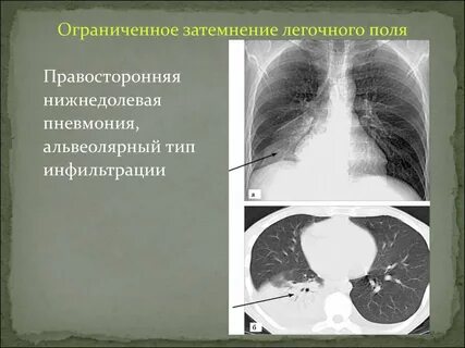 Типы инфильтрации легких