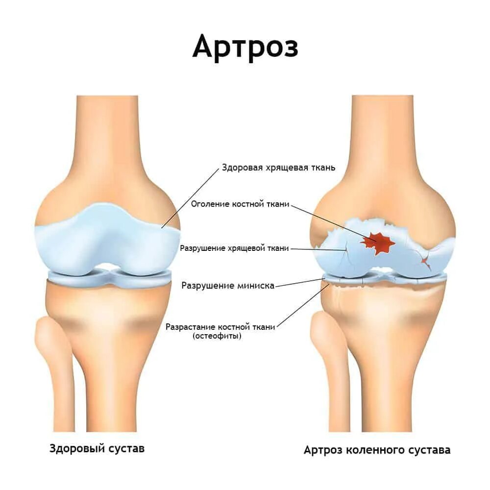 Можно вылечить артроз суставов. Остеоартрит коленного сустава. деформирующий гонартроз 1. деформирующий гонартроз 1 степени. правосторонний деформирующий гонартроз 1 степени.