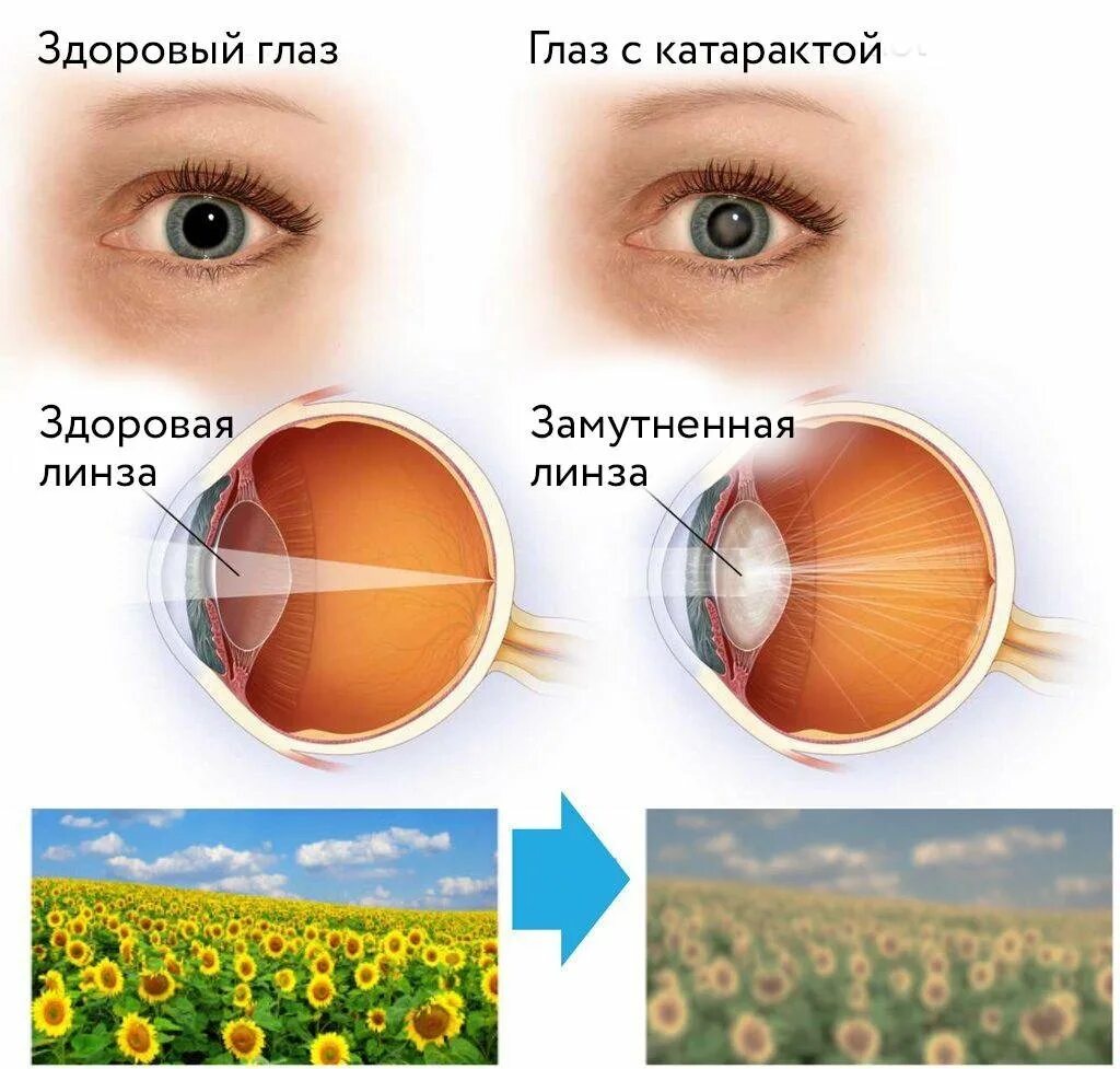 Катаракта – помутнение хрусталика глаза.. Здоровые глаза. Здоровый глаз и глаз с катарактой.