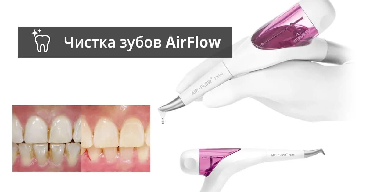 Чистка айр фло. Air Flow АИР флоу. Профгигиена зубов Air Flow. Снятие зубного налета методом Air Flow.