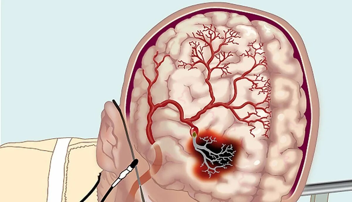 Ишемия смерть. Атеросклероз артерий головного мозга макропрепарат. Атеросклероз сосудов головного мозга макропрепарат. Сосудистые заболевания головного мозга ОНМК. Инсульт острое нарушение мозгового кровообращения.