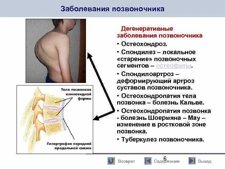 Болезни спины и позвоночника. Дегенеративно-дистрофические заболевания позвоночника. Изменения позвоночника. Дегенеративные поражения позвоночника. Дегенеративно дистрофические изменения шейного позвоночника.