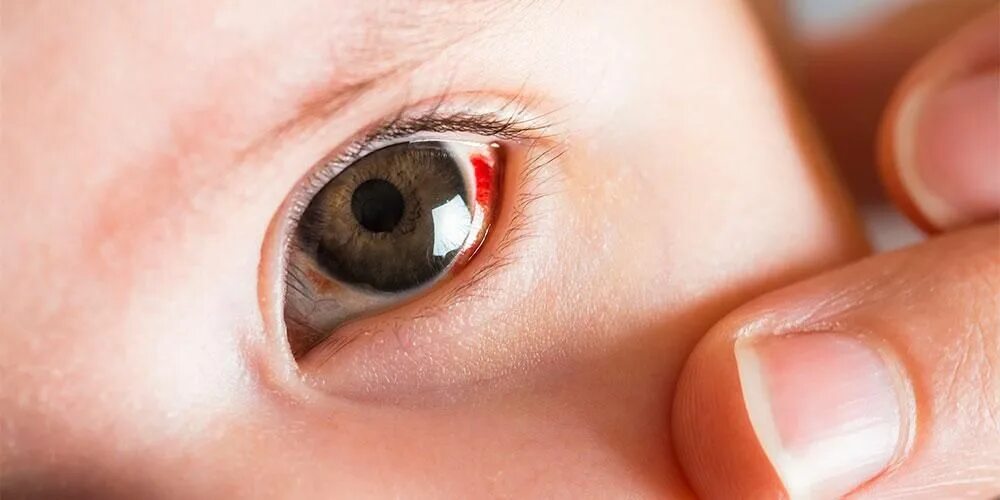 Субконъюнктивальное кровоизлияние у новорожденных. Субконъюнктивальное кровоизлияние в глазу. Блестят красные глазки
