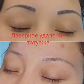 Удаление татуажа форум