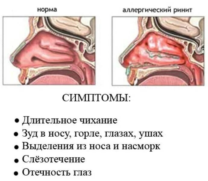 Заложенность носа слизью. Воспаление слизистой носа.