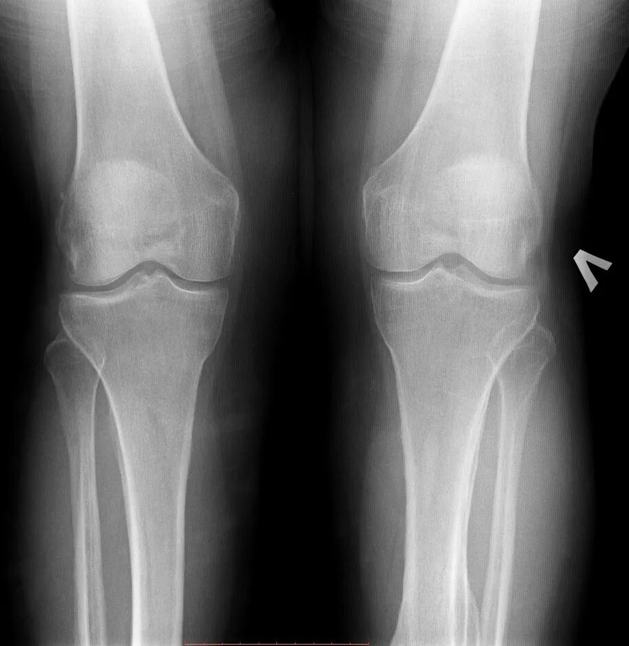 Менископатия коленного сустава рентген. Перелом мениска рентген. Повреждение мениска на рентгене.