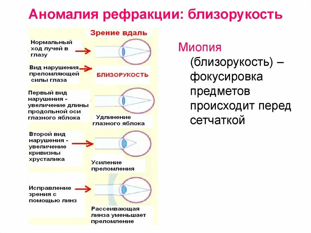 Какое преимущество дает зрение. Аномалии рефракции глаза близорукость дальнозоркость астигматизм. Нарушение рефракции и аккомодации глаза. Методы коррекции аномалий рефракции. Аномалии рефракции глаза схема.