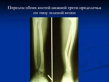 У ребенка часто переломы костей