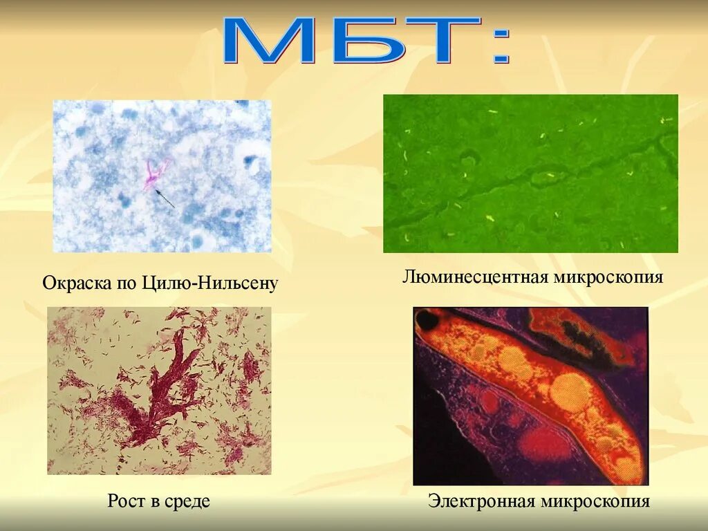 Микобактерии туберкулеза микроскопия по Цилю Нильсену. Окраска кислотоустойчивых бактерий по Цилю Нильсену. Световая микроскопия Циль Нильсену. Микобактерии туберкулеза по Циля-Нильсена.