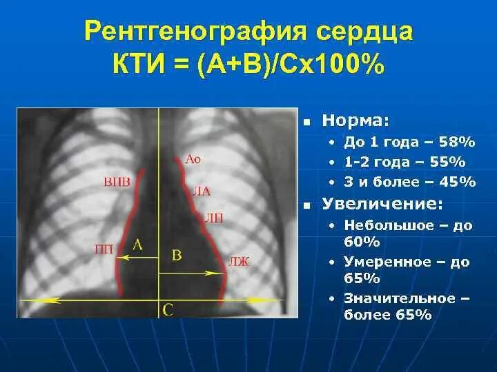 Норма форма сердца. КТИ рентген норма у детей. Размеры сердца наирентгенограмме. Рентгенография сердца в норме.