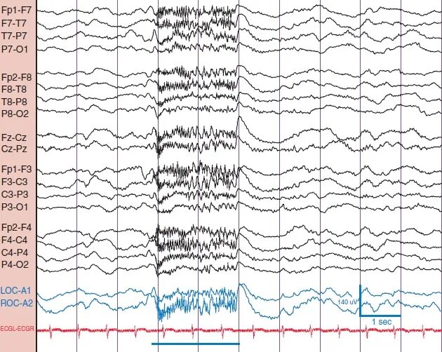 Пароксизмальная ээг. Пароксизмальная активность на ЭЭГ. Пароксизмальная активность при ЭЭГ. Пароксизмальная активность головного мозга на ЭЭГ. Эпилептиформная активность на ЭЭГ.