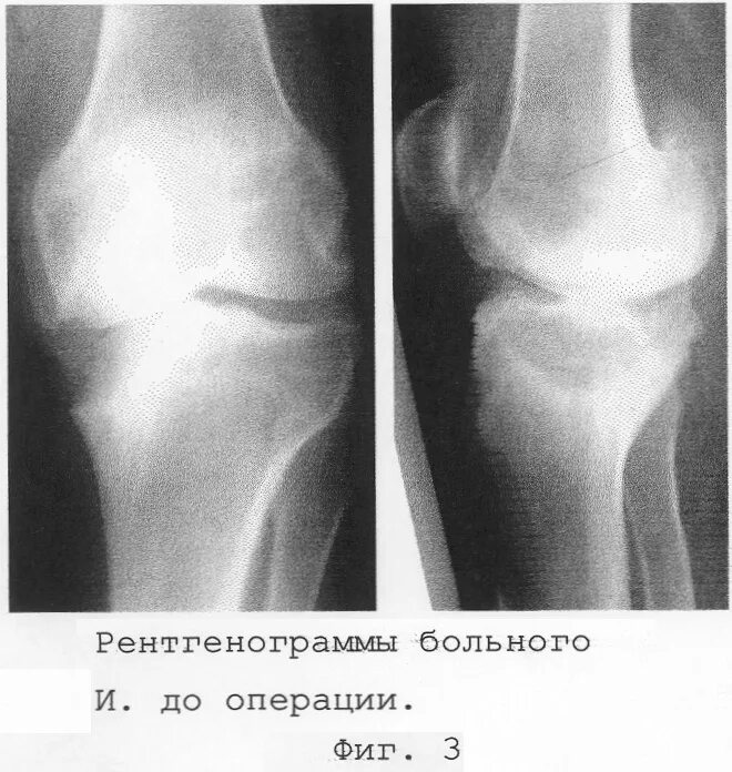 Асептический некроз коленного сустава. Асептический некроз коленного кости. Асептический некроз медиального мыщелка. Асептический некроз коленного сустава рентген.
