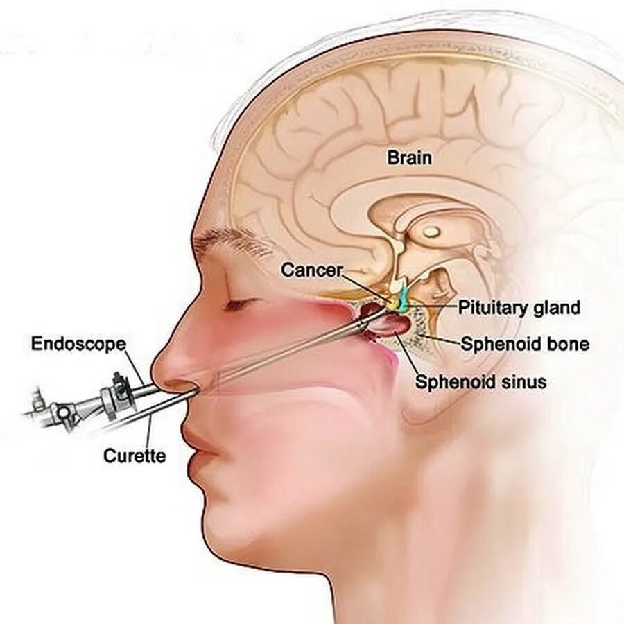 Нос и головной мозг. Опухоль микроаденома гипофиза. Аденома гипофиза пролактинома. Гипофиз и клиновидная пазуха. Макроадентма гипофиза.