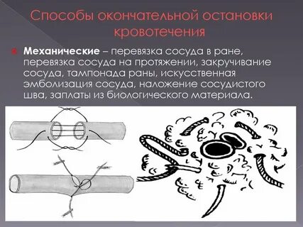 Для остановки кровотечения механическим способом применяют