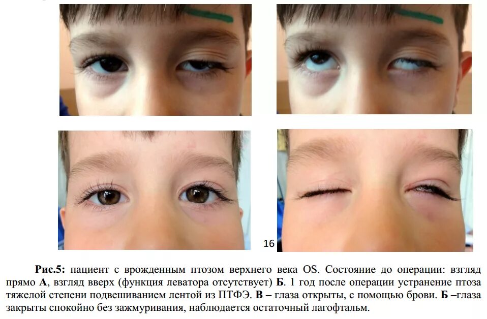 Веко верхнее птоз 1 степени. Птоз ( опущение верхнего века. Птоз верхнего века после операции. Глазная клиника птоз верхнего века. Нависло верхнее веко причины