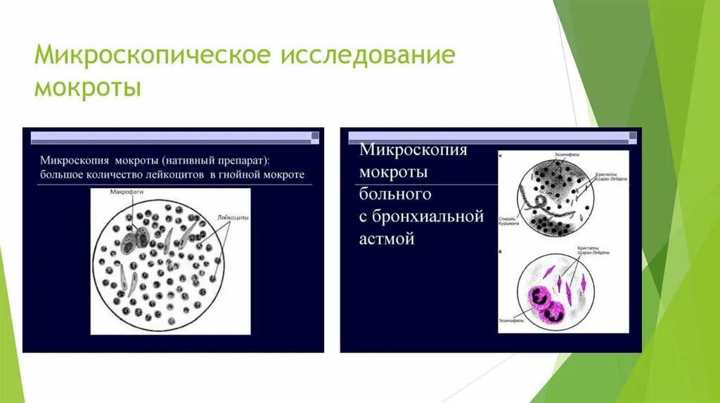 В мокроте можно обнаружить. Микроскопия мокроты токсокароз. Микроскопия мокроты атлас. Макроскопическое исследование мокроты. Исследование мокроты микроскопия.