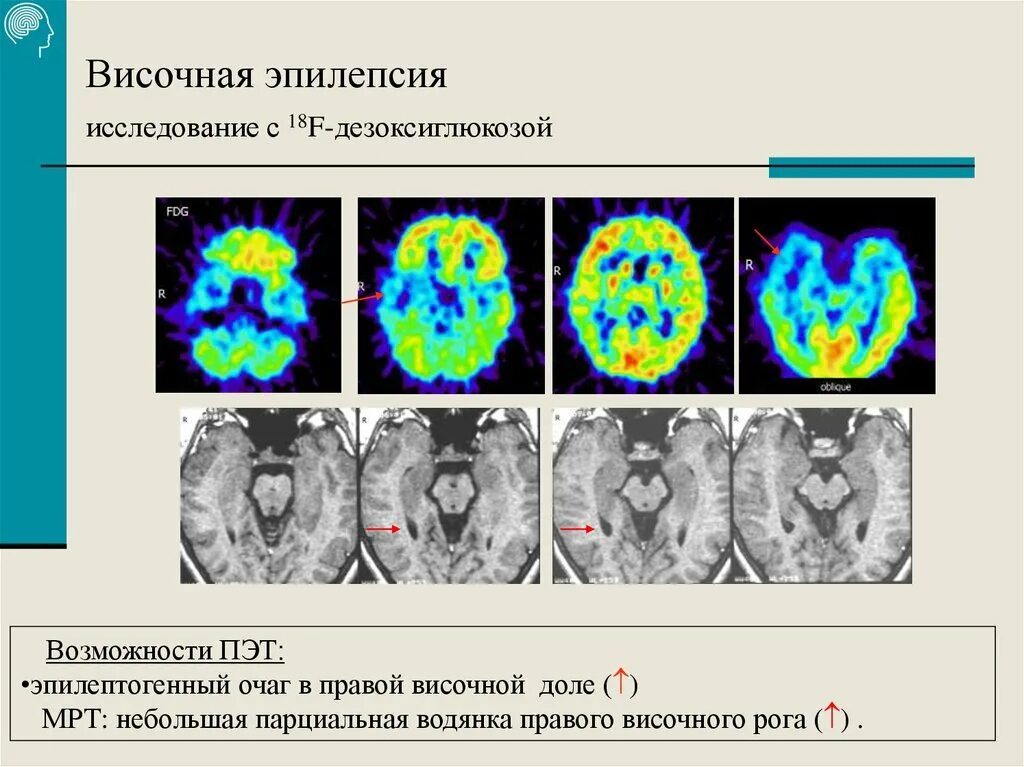 Исследование эпилепсии. ПЭТ-кт головного мозга при эпилепсии. ПЭТ кт эпилепсия. ПЭТ кт при эпилепсии. Эпилепсия височных долей.