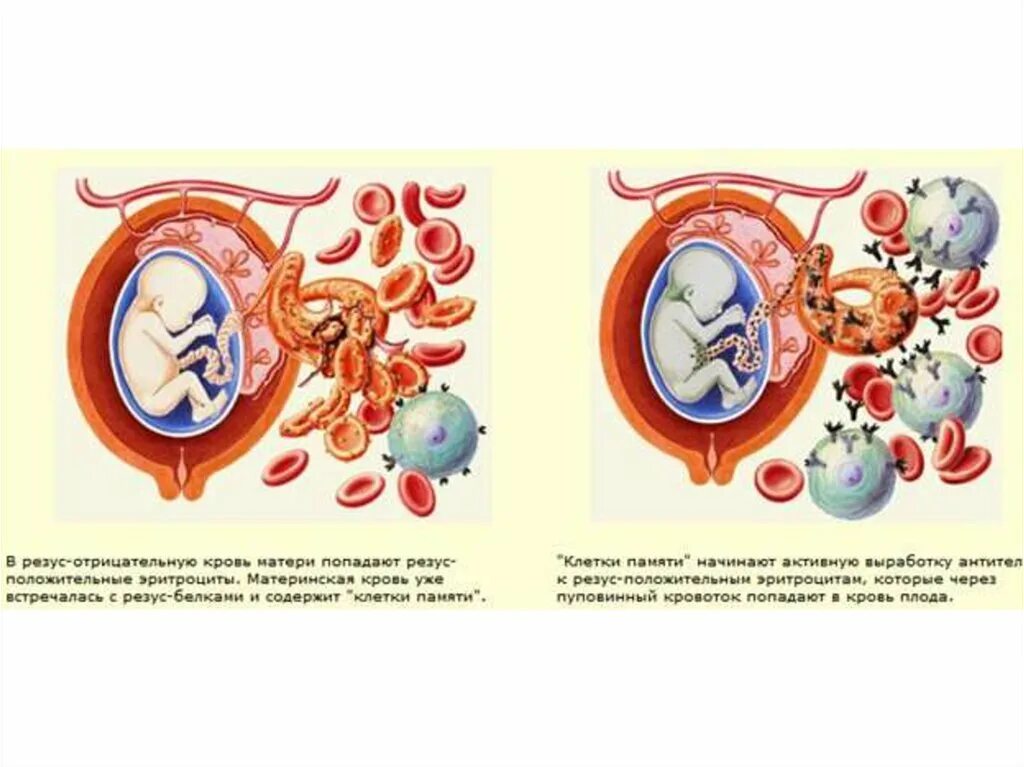 Резус конфликт. Резус-конфликт матери и плода. Резус отрицательный. Резус фактор матери и плода. Кровь несовместимость резусов