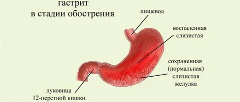 Частые гастриты