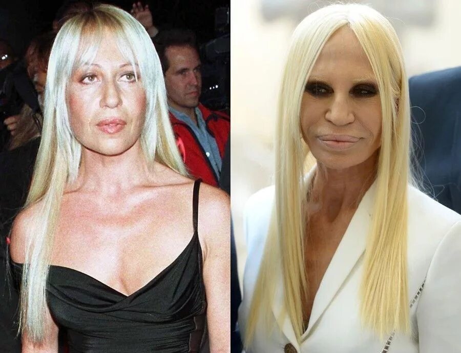 donatella versace - a before and after Celebrity plastic surgery, Donatella vers