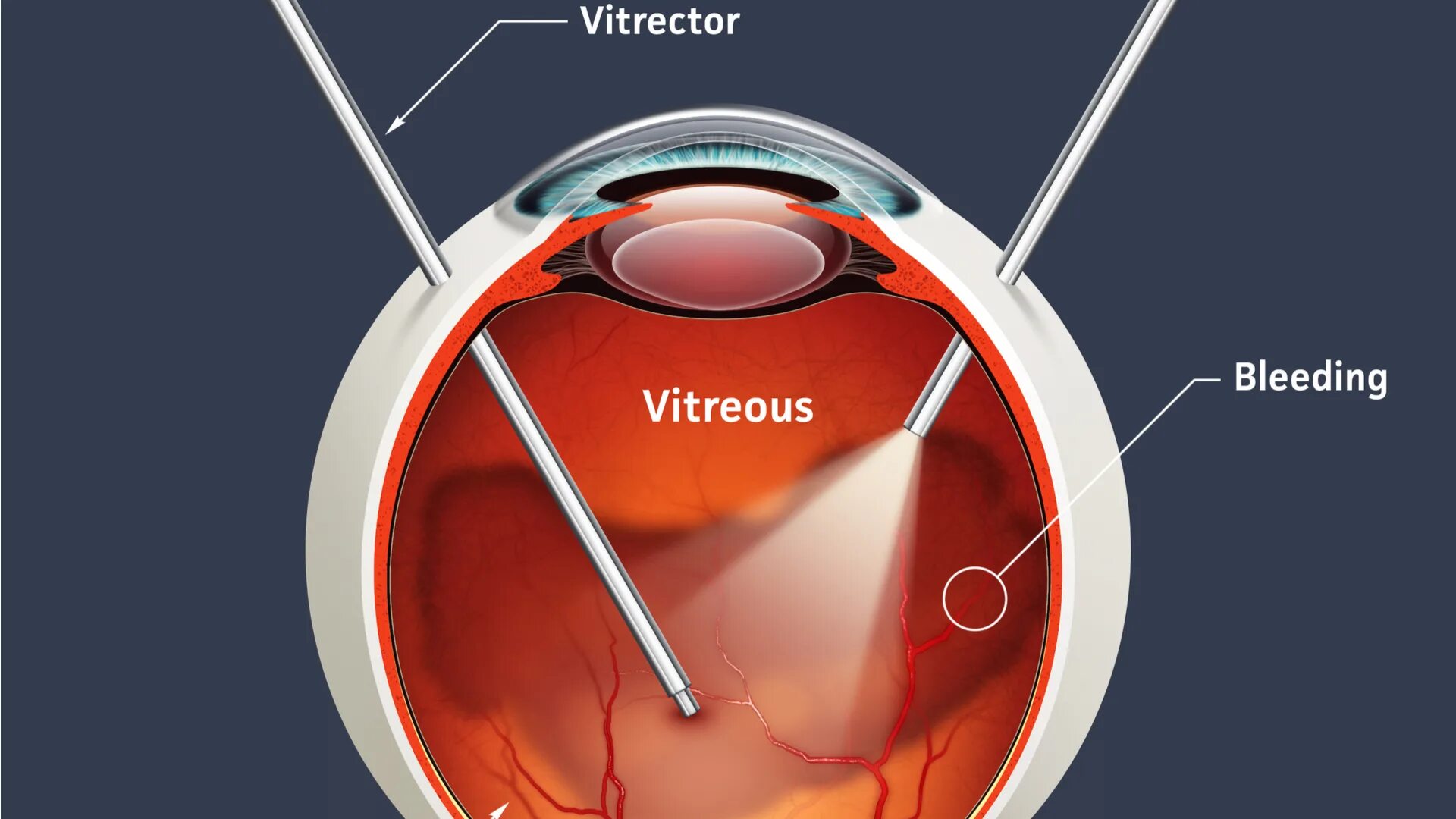Витреолизис цена. Витрэктомия ретинопатия. Витрэктомия сетчатки глаза. Субтотальная витрэктомия. Витреоретинальная хирургия.