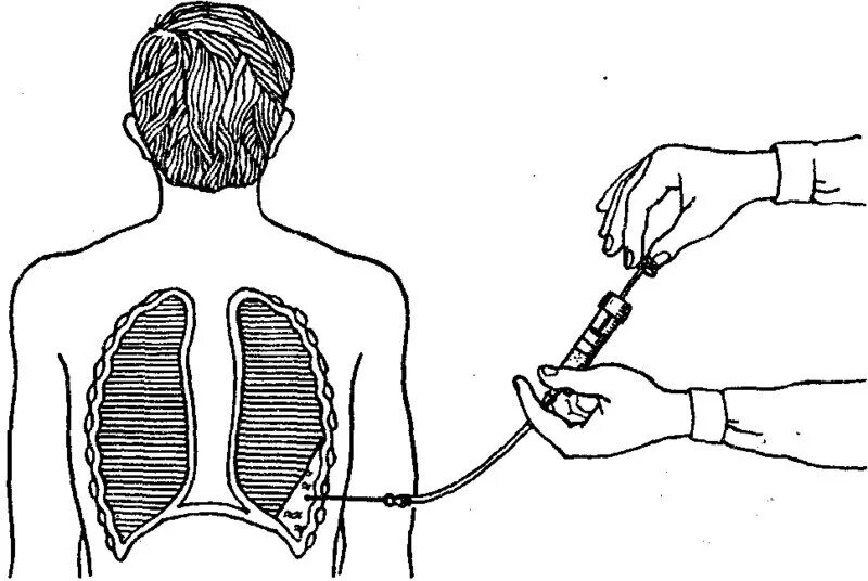 Разгрузочная пункция плевральной полости. Пункция и дренирование плевральной полости. Плевральная пункция торакоцентез. Пункция плевральной полости схема.