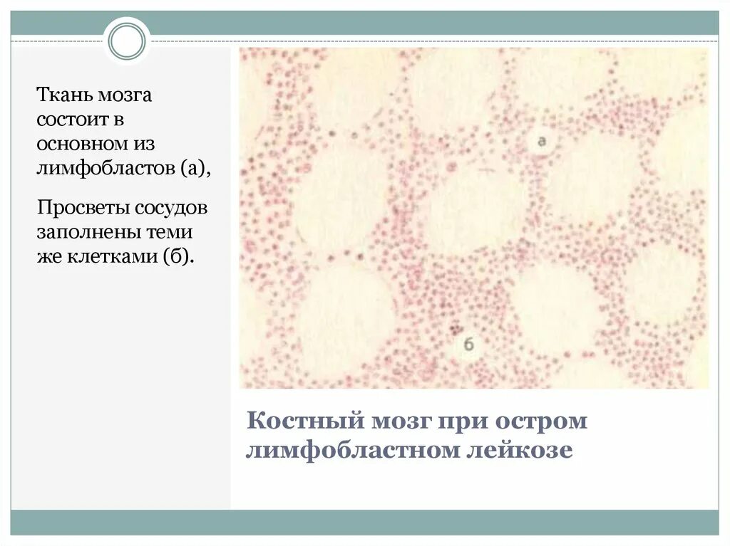 Мозг при остром лейкозе. Лимфобластный лейкоз гистология. Острый лимфобластный лейкоз гистология. Лимфолейкоз гистология. Острый лимфобластный лейкоз костный мозг.