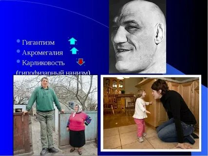 Акромегалия карликовость