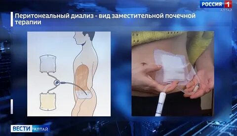 Перитонеальный диализ