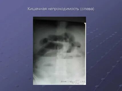 Кишечная непроходимость рекомендация