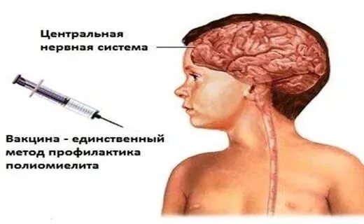 Полиомиелит вызывается. Вирус полиомиелита. Самая опасная форма полиомиелита. Самая опасная форма полиомиелита. Самая опасная форма полиомиелита.