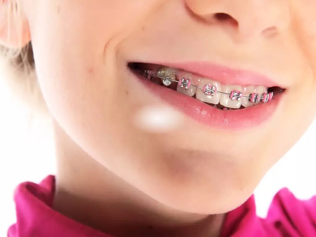 Поставить ребенку скобы. Скобы для зубов металлические. Пластина для выпрямления зубов. Поставить ребенку скобы. Скобы для зубов детские.