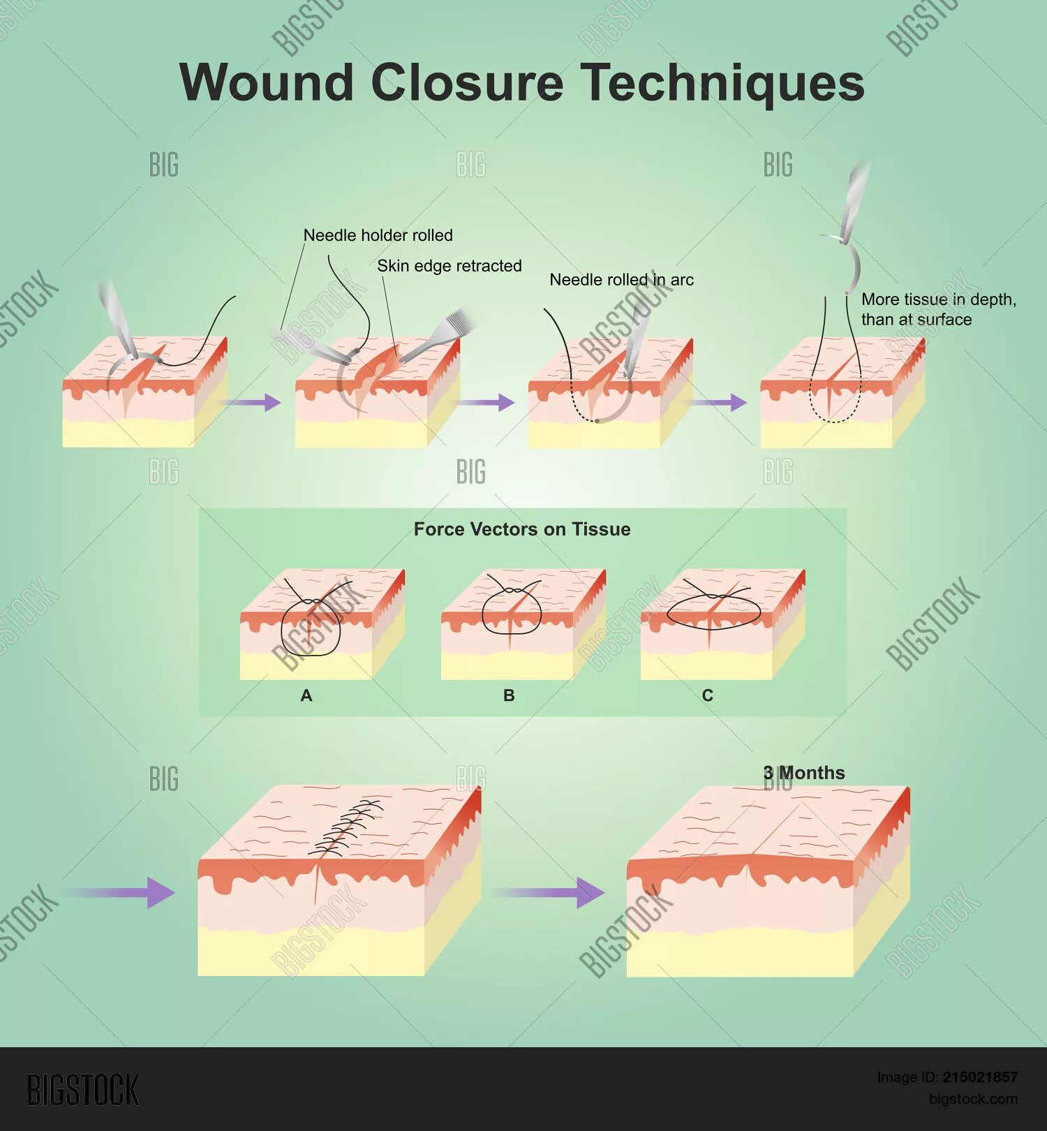 Types of wound. Types of wound