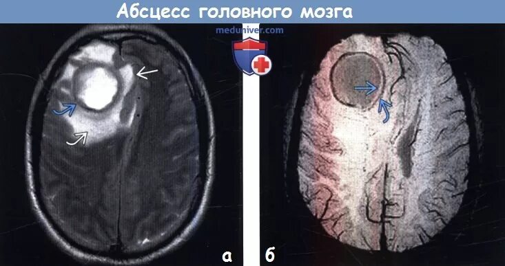 Субдуральный абсцесс головного мозга мрт. Абсцесс височной доли головного мозга кт.